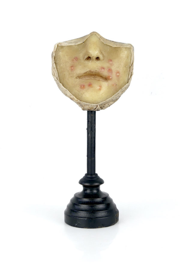 Céroplastie herpès du visage en cire sur pied (face)