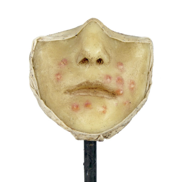 Céroplastie herpès du visage en cire sur pied (face)