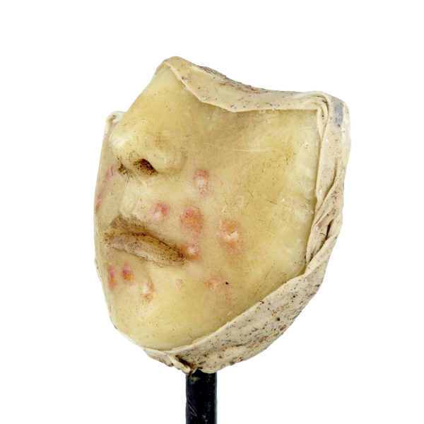 Céroplastie herpès du visage en cire sur pied (3/4)