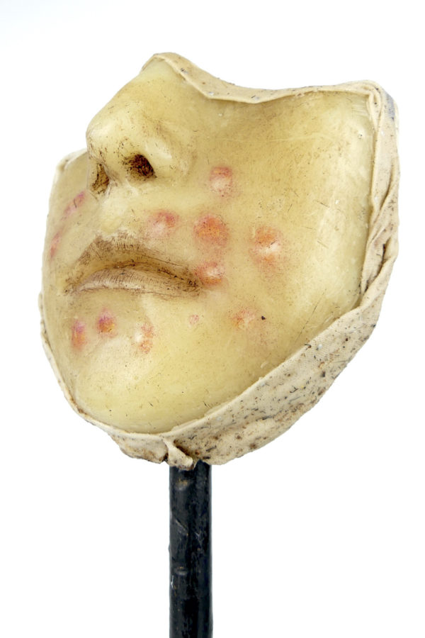 Céroplastie herpès du visage en cire sur pied (3/4)