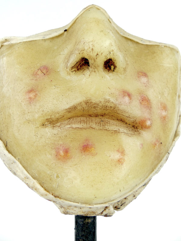 Céroplastie herpès du visage en cire sur pied (détail)