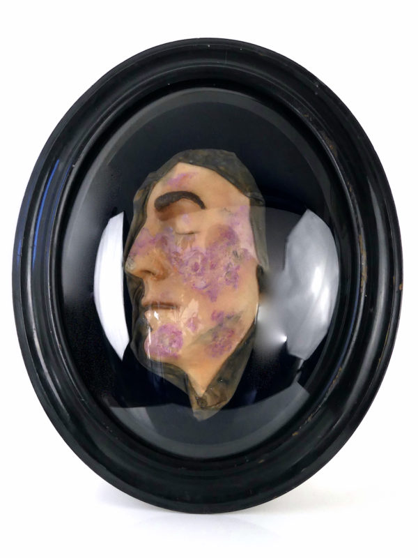 Visage de lépreux en cire sous verre bombé Napoléon III Céroplastie (face)
