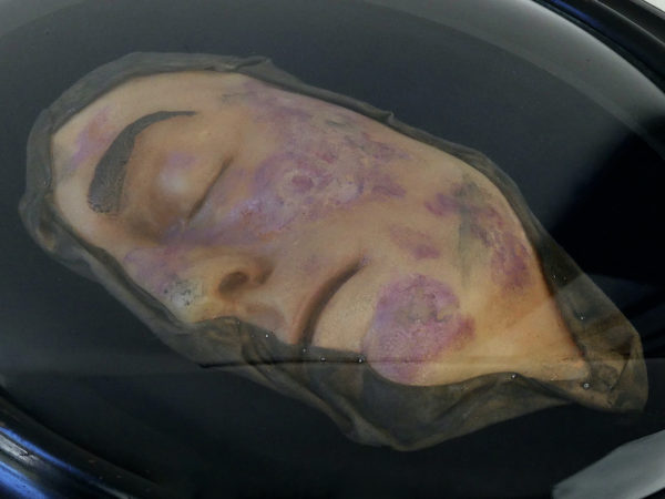 Visage de lépreux en cire sous verre bombé Napoléon III Céroplastie (détail 3/4)