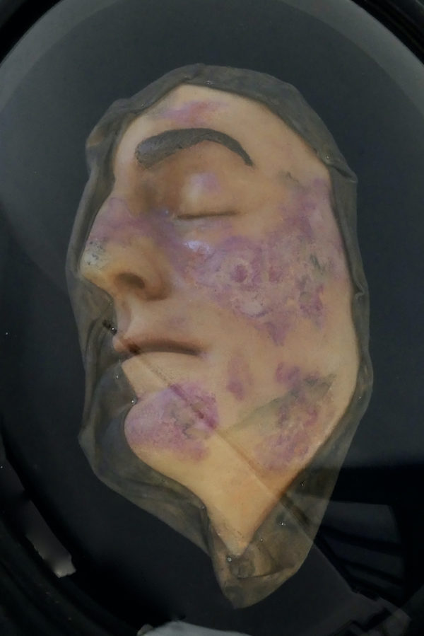 Visage de lépreux en cire sous verre bombé Napoléon III Céroplastie (détail)