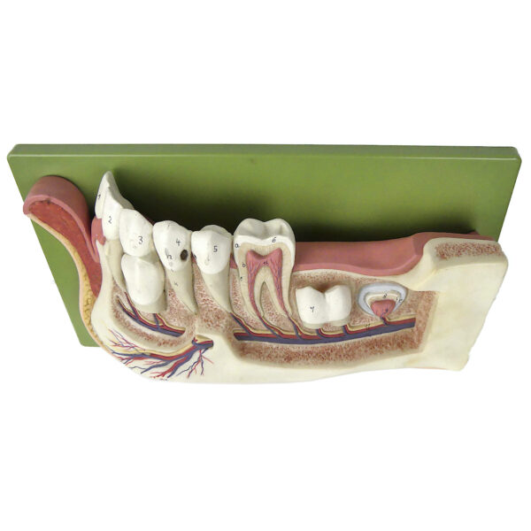 Mandibule d'enfant de 12 ans didactique SOMSO sur socle Allemagne (dessus 3/4)